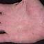 452. Dry Eczema on Hands Pictures
