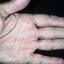 454. Dry Eczema on Hands Pictures