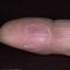 455. Dry Eczema on Hands Pictures