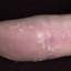 456. Dry Eczema on Hands Pictures