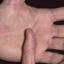 458. Dry Eczema on Hands Pictures