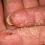46. Dry Eczema on Hands Pictures