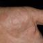460. Dry Eczema on Hands Pictures
