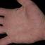 463. Dry Eczema on Hands Pictures