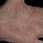 466. Dry Eczema on Hands Pictures
