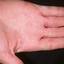 469. Dry Eczema on Hands Pictures