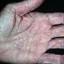 470. Dry Eczema on Hands Pictures