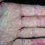 471. Dry Eczema on Hands Pictures