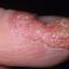 50. Dry Eczema on Hands Pictures