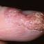 51. Dry Eczema on Hands Pictures