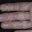 54. Dry Eczema on Hands Pictures