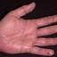 6. Dry Eczema on Hands Pictures
