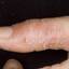 61. Dry Eczema on Hands Pictures