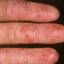 64. Dry Eczema on Hands Pictures