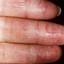 66. Dry Eczema on Hands Pictures