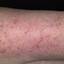 7. Dry Eczema on Hands Pictures