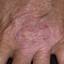 75. Dry Eczema on Hands Pictures