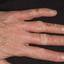 76. Dry Eczema on Hands Pictures