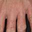 77. Dry Eczema on Hands Pictures