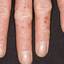 78. Dry Eczema on Hands Pictures