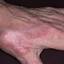 79. Dry Eczema on Hands Pictures