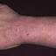 8. Dry Eczema on Hands Pictures