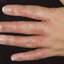 86. Dry Eczema on Hands Pictures