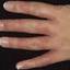 87. Dry Eczema on Hands Pictures