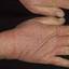 91. Dry Eczema on Hands Pictures