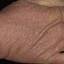 92. Dry Eczema on Hands Pictures