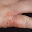 95. Dry Eczema on Hands Pictures