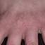 99. Dry Eczema on Hands Pictures