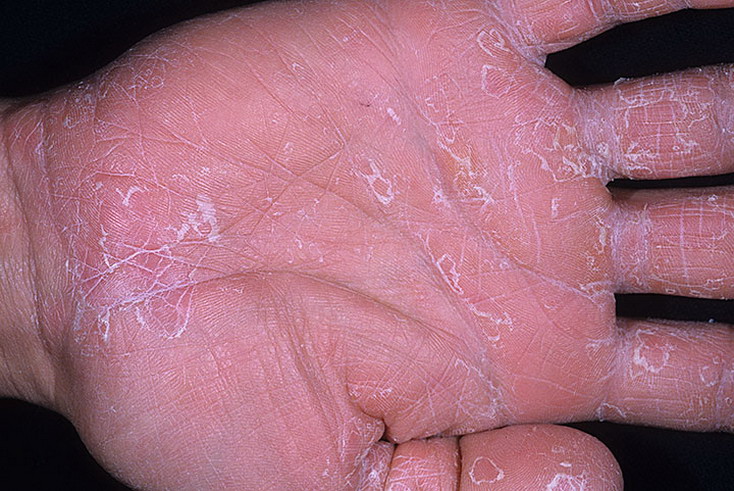 Dry Eczema on Hands Pictures – 475 Photos & Images / illnessee.com