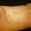 15. Eczema Tyloticum Pictures
