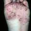 21. Eczema Tyloticum Pictures