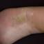 9. Eczema Tyloticum Pictures