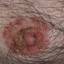 1. Nervous Eczema Pictures