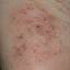 41. Nervous Eczema Pictures