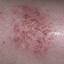 45. Nervous Eczema Pictures