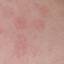 50. Nervous Eczema Pictures