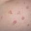 53. Nervous Eczema Pictures