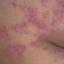58. Nervous Eczema Pictures