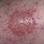 60. Nervous Eczema Pictures