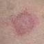 61. Nervous Eczema Pictures