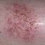 105. Wet Eczema Pictures