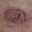 110. Wet Eczema Pictures
