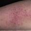 130. Wet Eczema Pictures