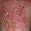136. Wet Eczema Pictures