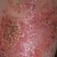 138. Wet Eczema Pictures