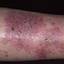 142. Wet Eczema Pictures